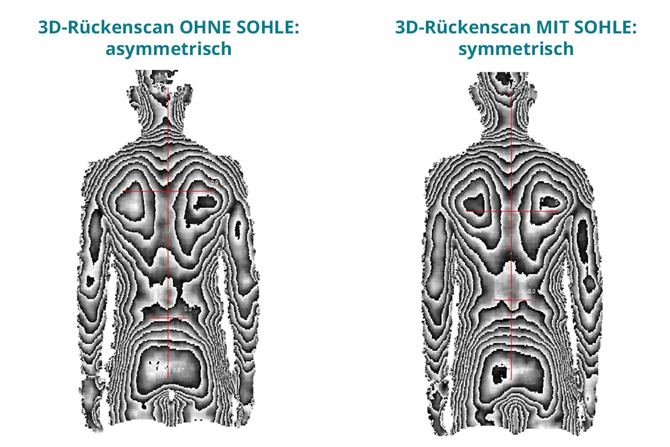 3d-rückenscan zeigt rücken vor und nach dem einsatz von sensomotorischen sohlen
